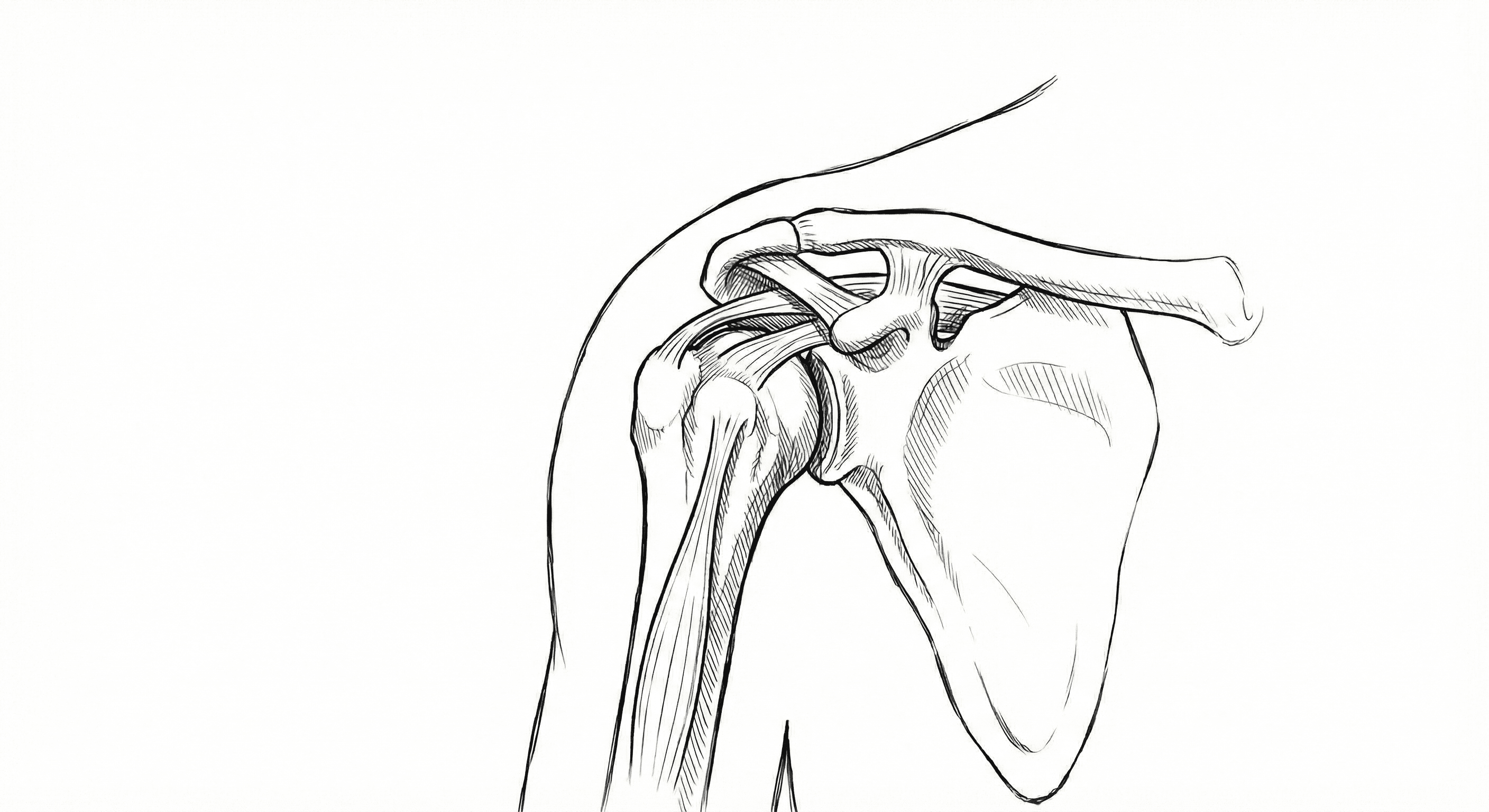 Réparation de lésions SLAP
