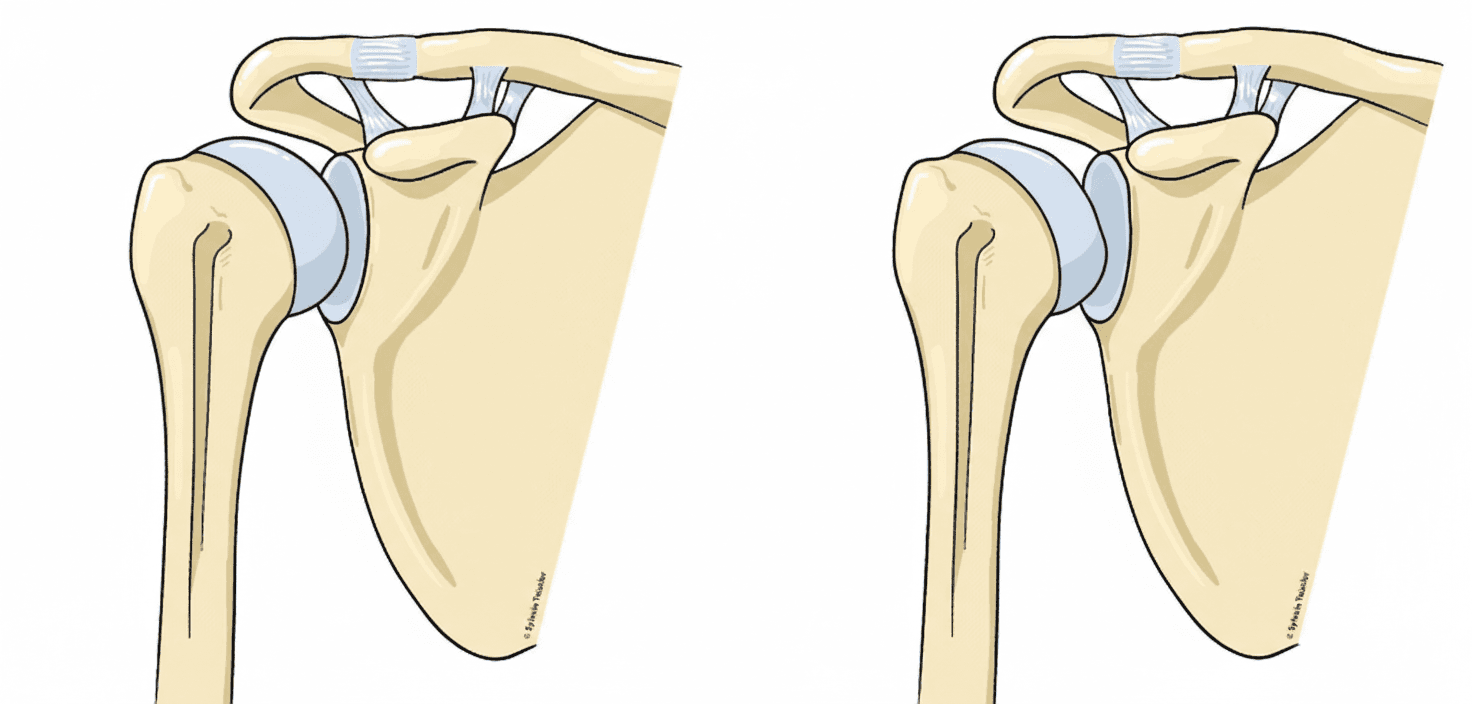 Arthrose de l'épaule